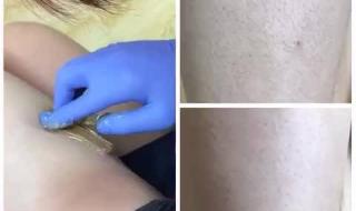 永久脱毛多少钱